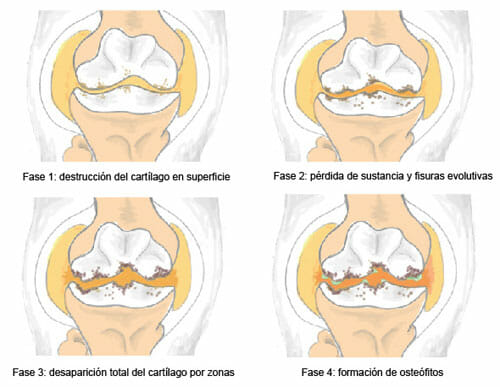 Artrosis periférica