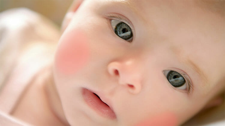Dermatitis atópica en niños