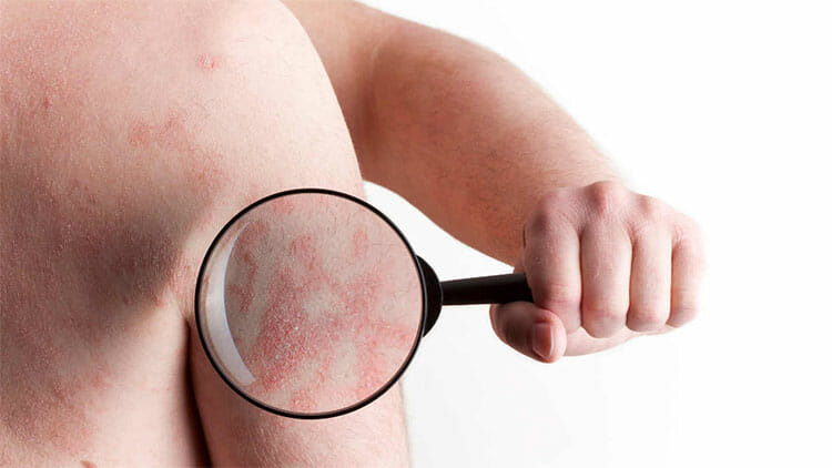 Psoriasis