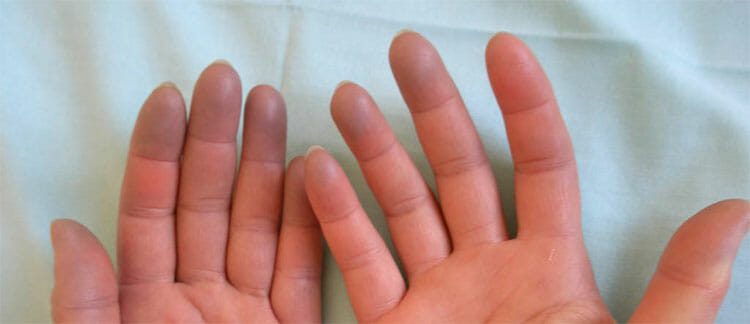 Acrocianosis
