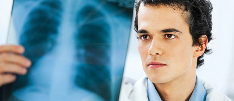 Asbestosis
