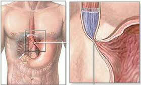 Causas de la acalasia