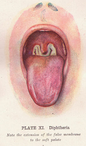 Garganta con difteria