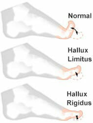 Hallux limitus - Pies