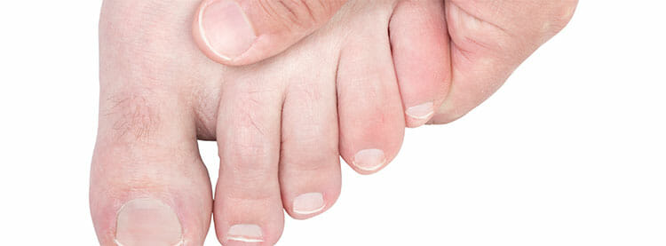 Hallux limitus