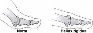 Hallux rigidus y huesos del pie