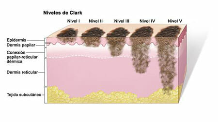 Melanoma - Niveles de Clark