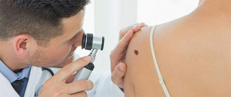 Melanoma