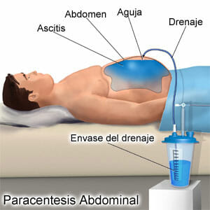 Paracentesis como tratamiento de la ascitis