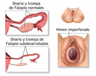 Posibles causas de la amenorrea