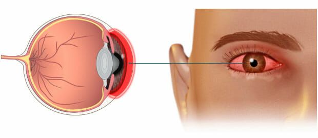 Infografía de la queratitis