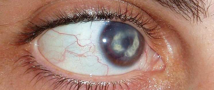 Queratitis
