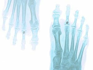 Hallux rigidus y Hallux limitus
