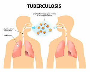 Tuberculosis pulmonar