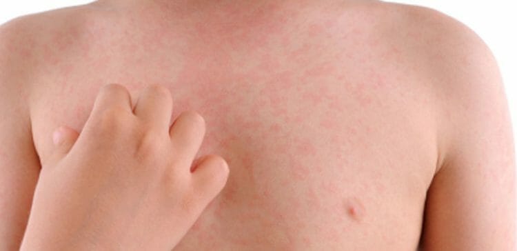 Urticaria: causas, síntomas, tipos y tratamiento