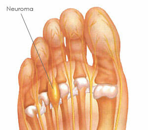 Anatomía de un pie con neuroma