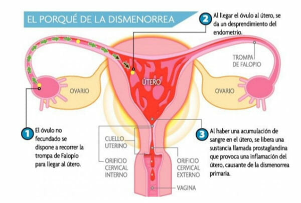 Causas de la dismenorrea