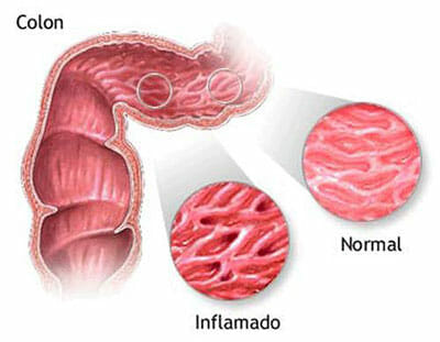 Colon inflamado por la enfermedad de Crohn