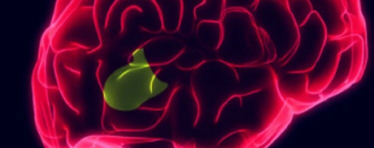 Como se diagnostica la afasia de Broca