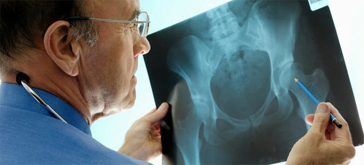 Fractura de cadera: causas, síntomas, diagnóstico y tratamiento