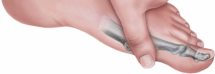 Hallux varus