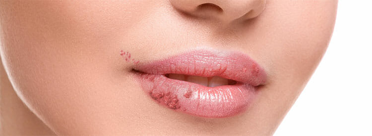 Remedios caseros para curar el herpes labial