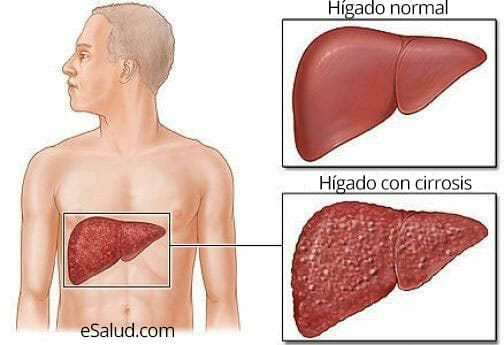 Hígado con cirrosis