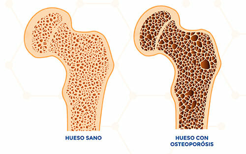 Hueso con osteoporosis