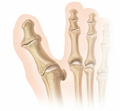 Hallux varus y huesos del pie