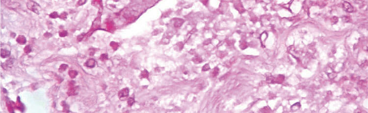 Mucormicosis