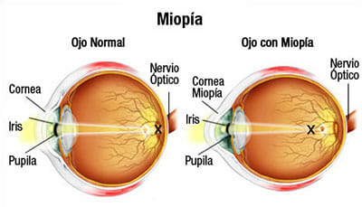 Ojo con miopía