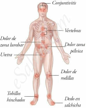 Síntomas del Síndrome de Reiter