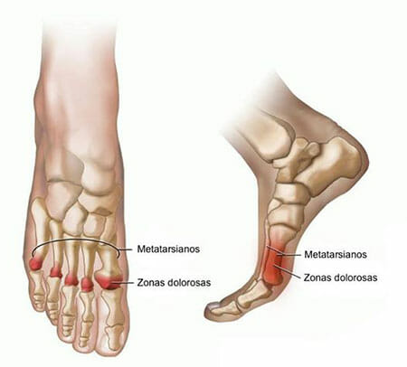 Zonas dolorosas de la metatarsalgia