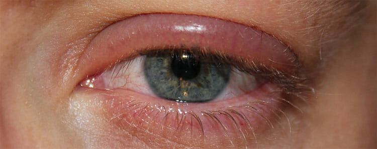 Blefaritis