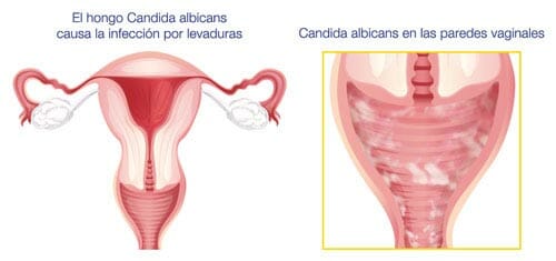 Causas de la candidiasis vaginal