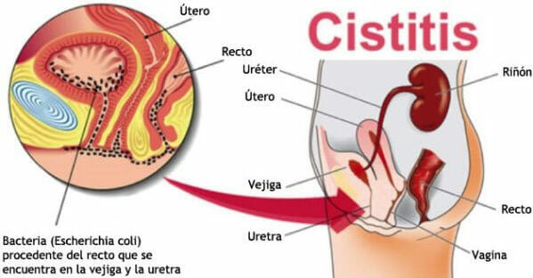Causas de la cistitis