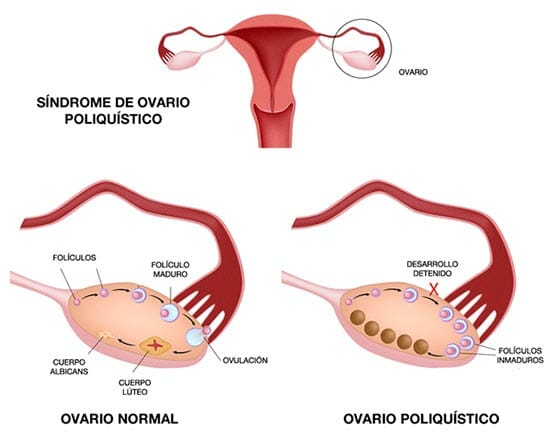Causas del síndrome del ovario poliquístico