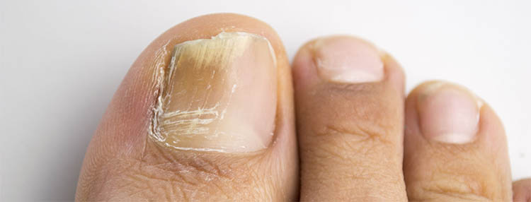 Onicomicosis