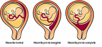 Tipos de placenta previa