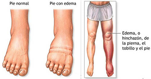 Síntomas del linfedema