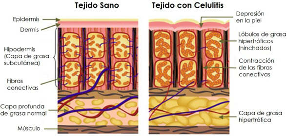 Tejido con celulitis