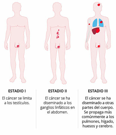 Estadios del cáncer testicular