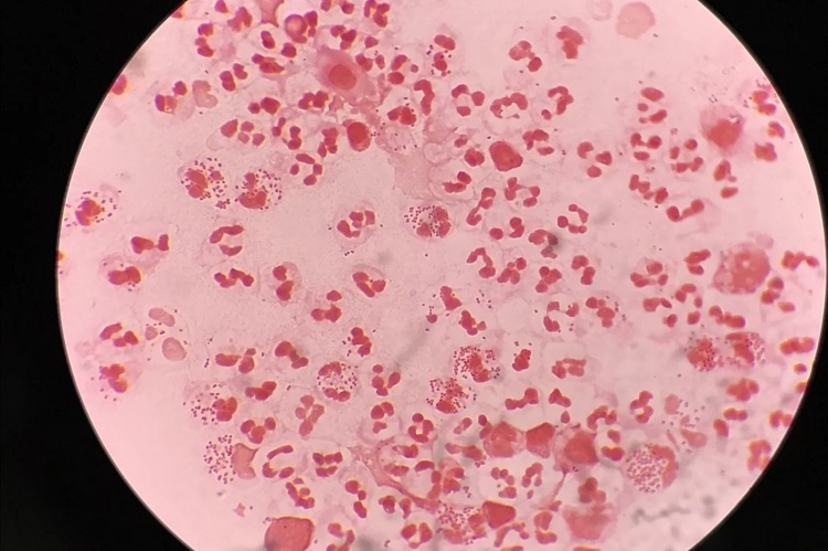 Gonorrea
