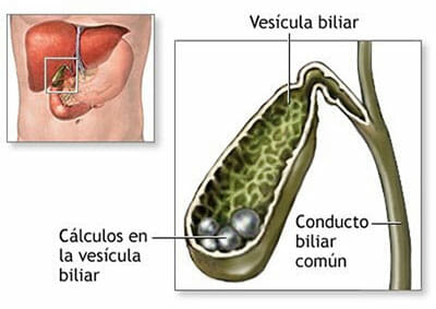 Causas de la litiasis biliar