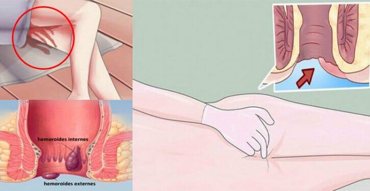 Cancer de ano o hemorroides