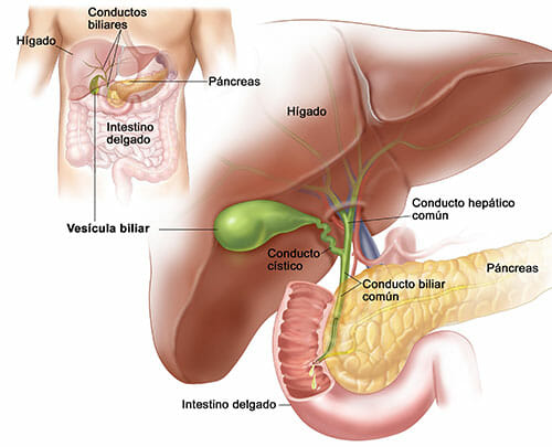 Causas de la colecistitis aguda
