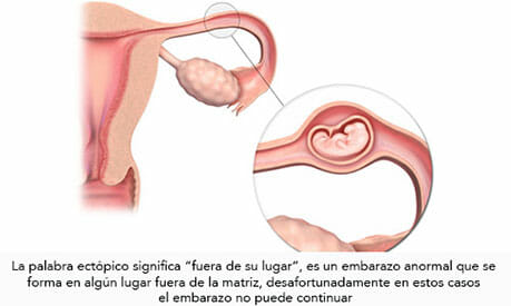 Causas y síntomas del embarazo ectópico