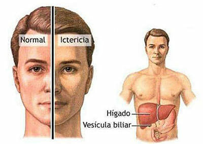 Causas de la encefalopatía hepática