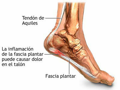 Causas de la fascitis plantar
