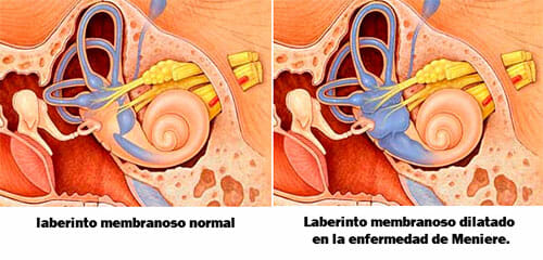 Causas del síndrome de Meniere